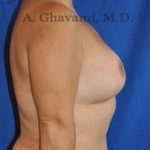 Breast Lift Before & After Patient #8779