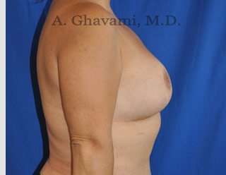 Breast Lift Before & After Patient #8779
