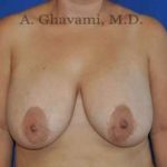 Breast Lift Before & After Patient #8779