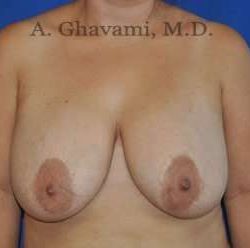 Breast Lift Before & After Patient #8779