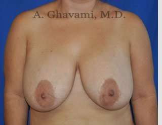 Breast Lift Before & After Patient #8779
