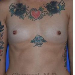 Breast Augmentation Before & After Patient #9060