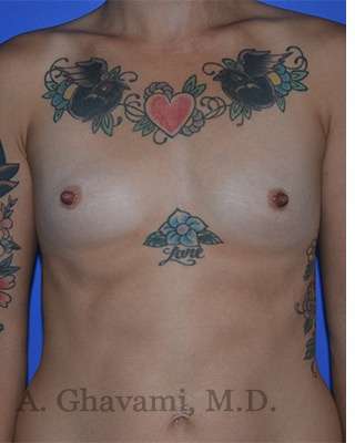 Breast Augmentation Before & After Patient #9060