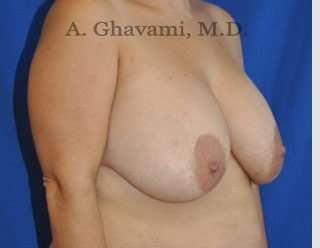 Breast Lift Before & After Patient #8779