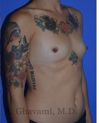 Breast Augmentation Before & After Patient #9060