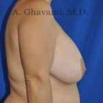 Breast Lift Before & After Patient #8779