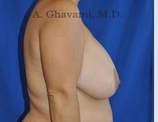 Breast Lift Before & After Patient #8779