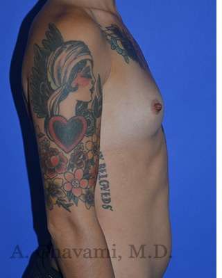 Breast Augmentation Before & After Patient #9060
