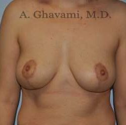 Breast Lift Before & After Patient #8772