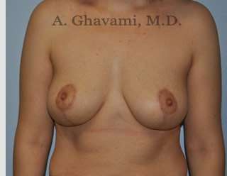 Breast Lift Before & After Patient #8772