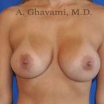 Breast Augmentation Before & After Patient #9053