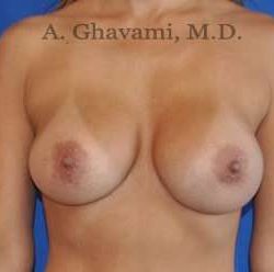 Breast Augmentation Before & After Patient #9053
