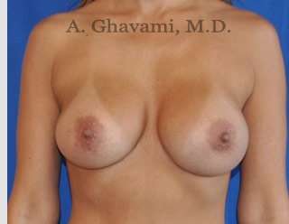 Breast Augmentation Before & After Patient #9053