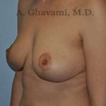 Breast Lift Before & After Patient #8772