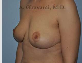 Breast Lift Before & After Patient #8772