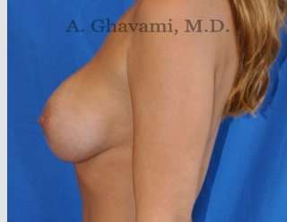 Breast Augmentation Before & After Patient #9053