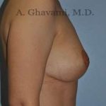 Breast Lift Before & After Patient #8772