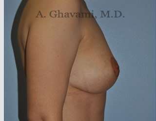 Breast Lift Before & After Patient #8772