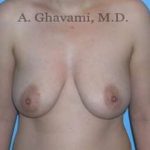 Breast Lift Before & After Patient #8772