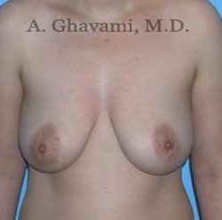 Breast Lift Before & After Patient #8772