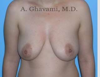 Breast Lift Before & After Patient #8772