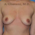 Breast Augmentation Before & After Patient #9053