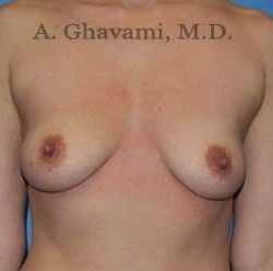 Breast Augmentation Before & After Patient #9053