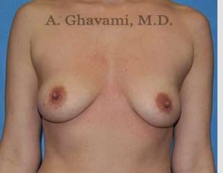 Breast Augmentation Before & After Patient #9053