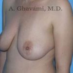 Breast Lift Before & After Patient #8772