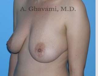 Breast Lift Before & After Patient #8772