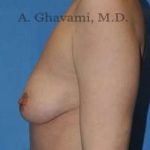 Breast Augmentation Before & After Patient #9053