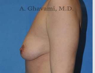Breast Augmentation Before & After Patient #9053
