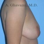 Breast Lift Before & After Patient #8772