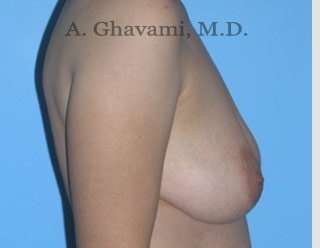 Breast Lift Before & After Patient #8772