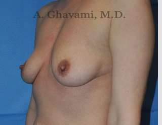 Breast Augmentation Before & After Patient #9053