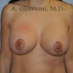 Breast Lift Before & After Patient #8765