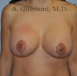Breast Lift Before & After Patient #8765