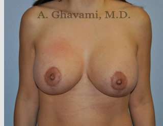 Breast Lift Before & After Patient #8765