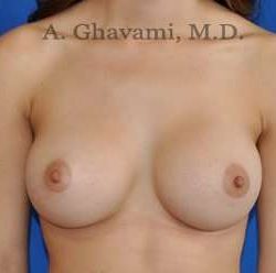 Breast Augmentation Before & After Patient #9046
