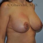 Breast Lift Before & After Patient #8765