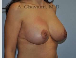 Breast Lift Before & After Patient #8765
