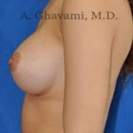 Breast Augmentation Before & After Patient #9046