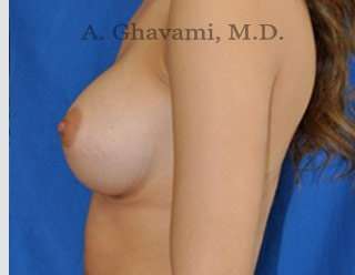 Breast Augmentation Before & After Patient #9046