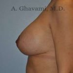 Breast Lift Before & After Patient #8765