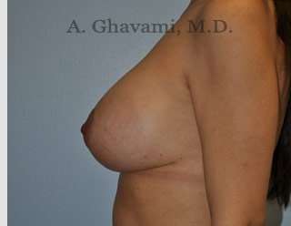 Breast Lift Before & After Patient #8765
