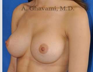 Breast Augmentation Before & After Patient #9046