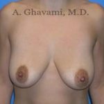 Breast Lift Before & After Patient #8765