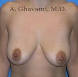 Breast Lift Before & After Patient #8765