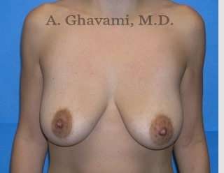 Breast Lift Before & After Patient #8765