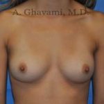 Breast Augmentation Before & After Patient #9046